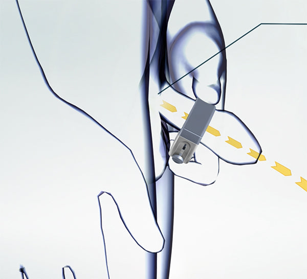 Harex®; behoud van de normale toilet-gang bij incontinentie voor mannen